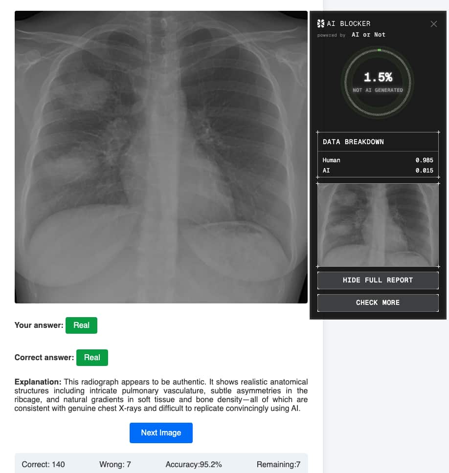 Authentic chest radiograph correctly identified by AI or Not as real (1.5% AI score)